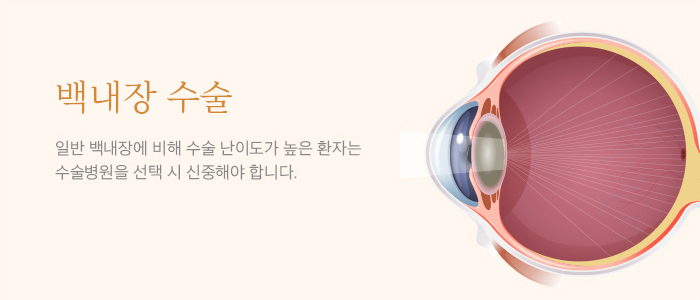 고난이도 백내장 수술